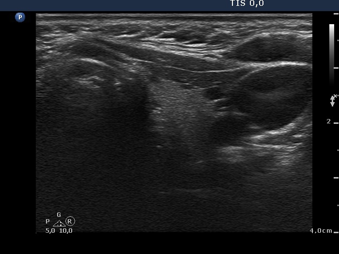 Right lobe, longitudinal scan