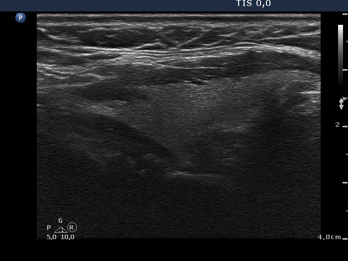 Right lobe, longitudinal scan