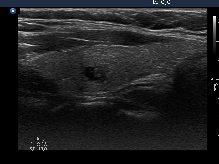 Right lobe, longitudinal scan