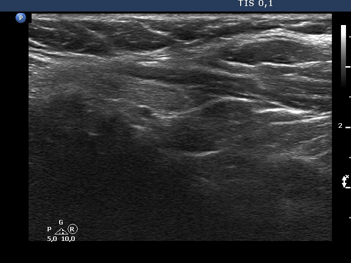 Right lobe, longitudinal scan