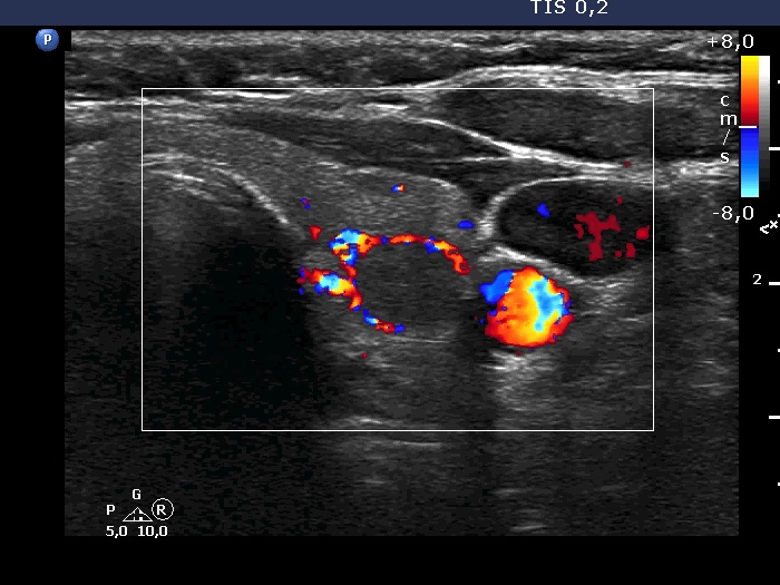 Right lobe, longitudinal scan