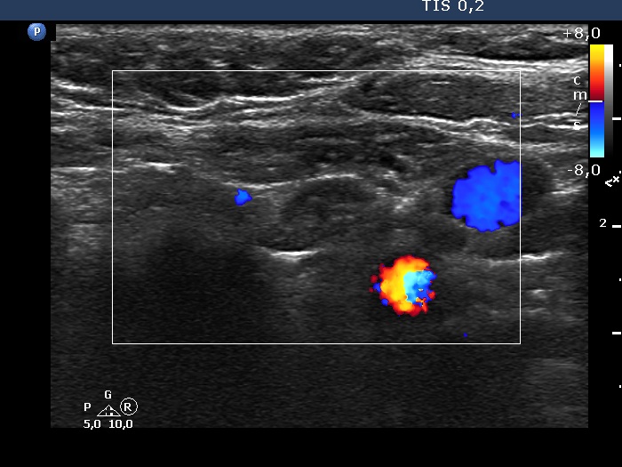 Right lobe, longitudinal scan