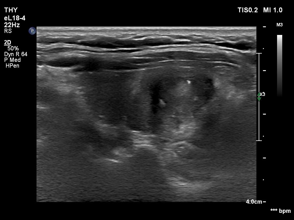 Right lobe, longitudinal scan