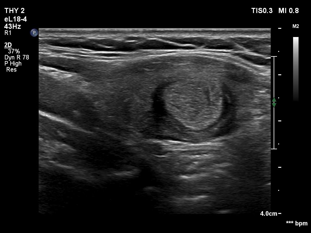 Right lobe, longitudinal scan