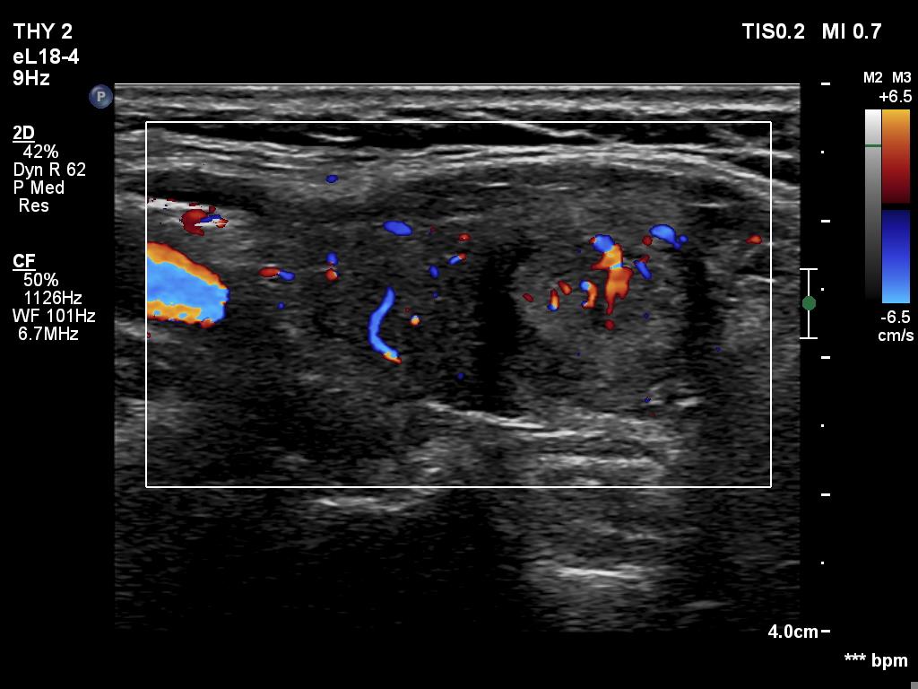 Right lobe, longitudinal scan