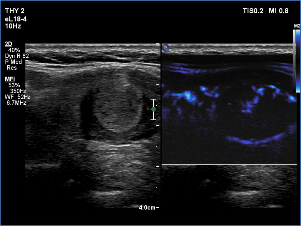 Right lobe, longitudinal scan