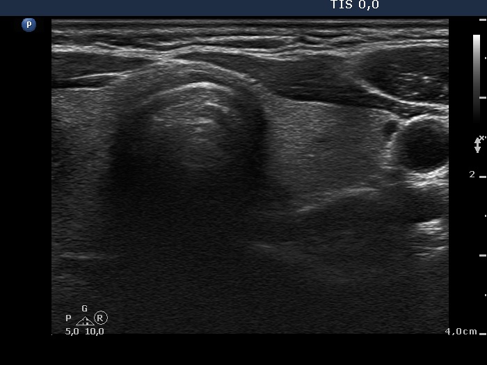 Right lobe, horizontal view