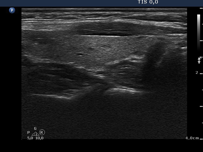 Right lobe, horizontal view