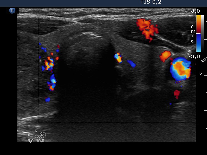 Right lobe, horizontal view