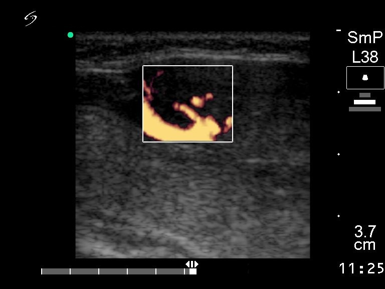 Right lobe, longitudinal scan