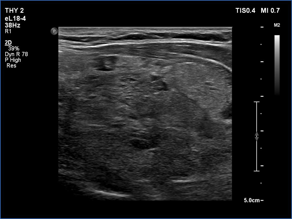 Right lobe, longitudinal scan