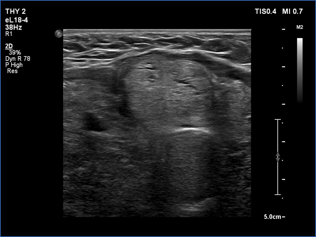 Right lobe, longitudinal scan