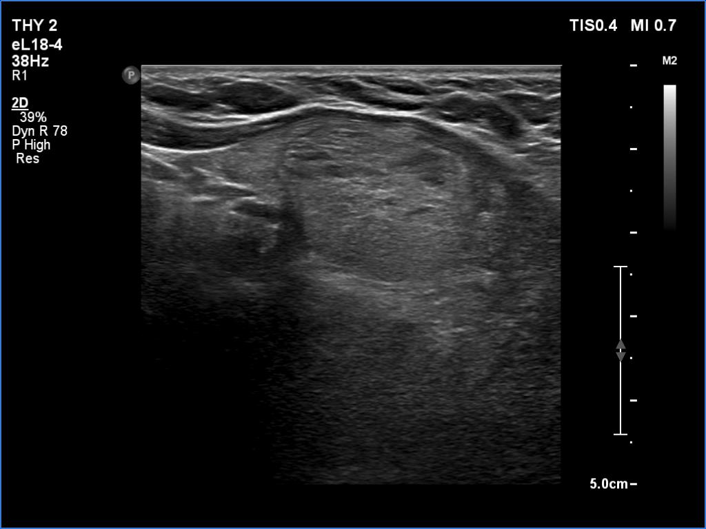 Right lobe, longitudinal scan