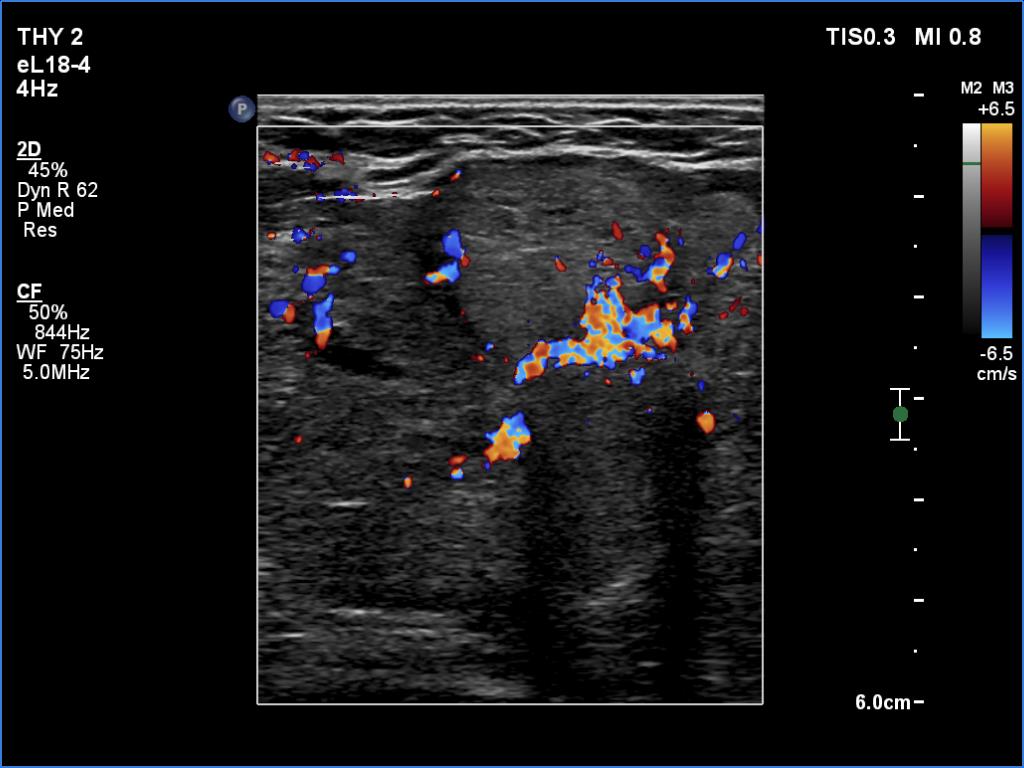 Right lobe, longitudinal scan