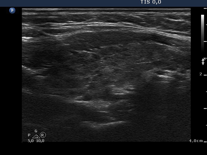 Right lobe, horizontal view