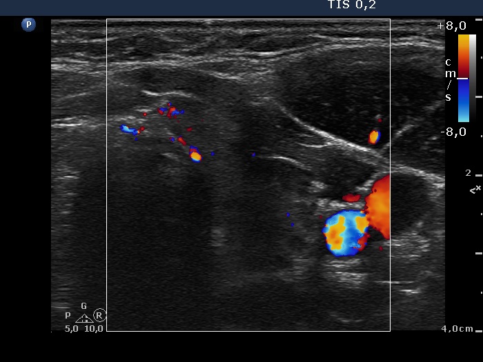 Right lobe, horizontal view