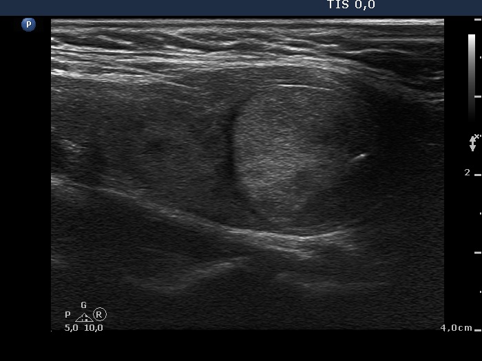 Right lobe, longitudinal scan