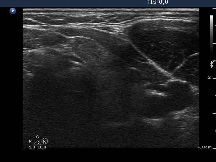 Right lobe, longitudinal scan