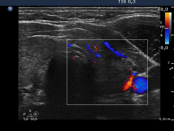 Right lobe, longitudinal scan
