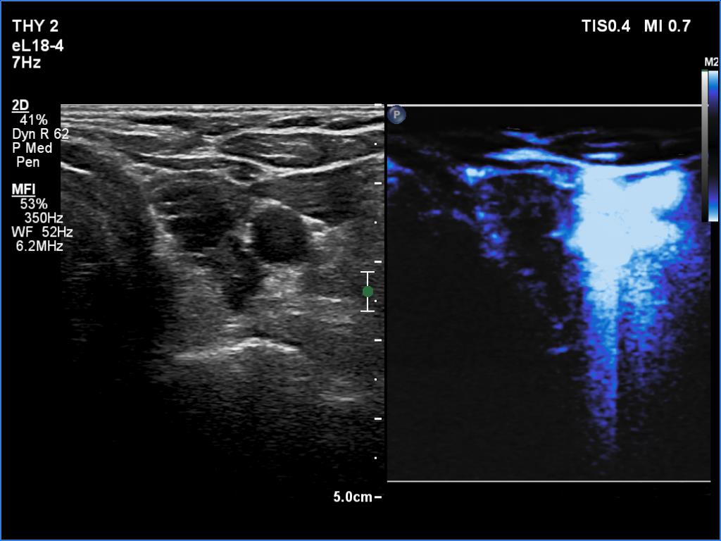 Right lobe, longitudinal scan