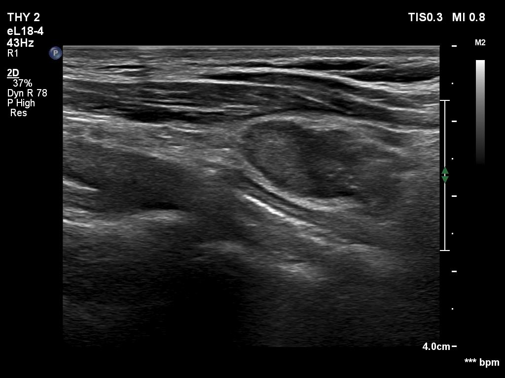 Right lobe, longitudinal scan