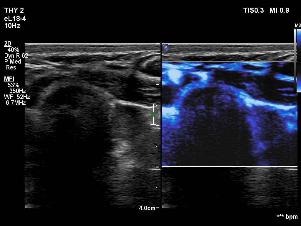 Right lobe, longitudinal scan