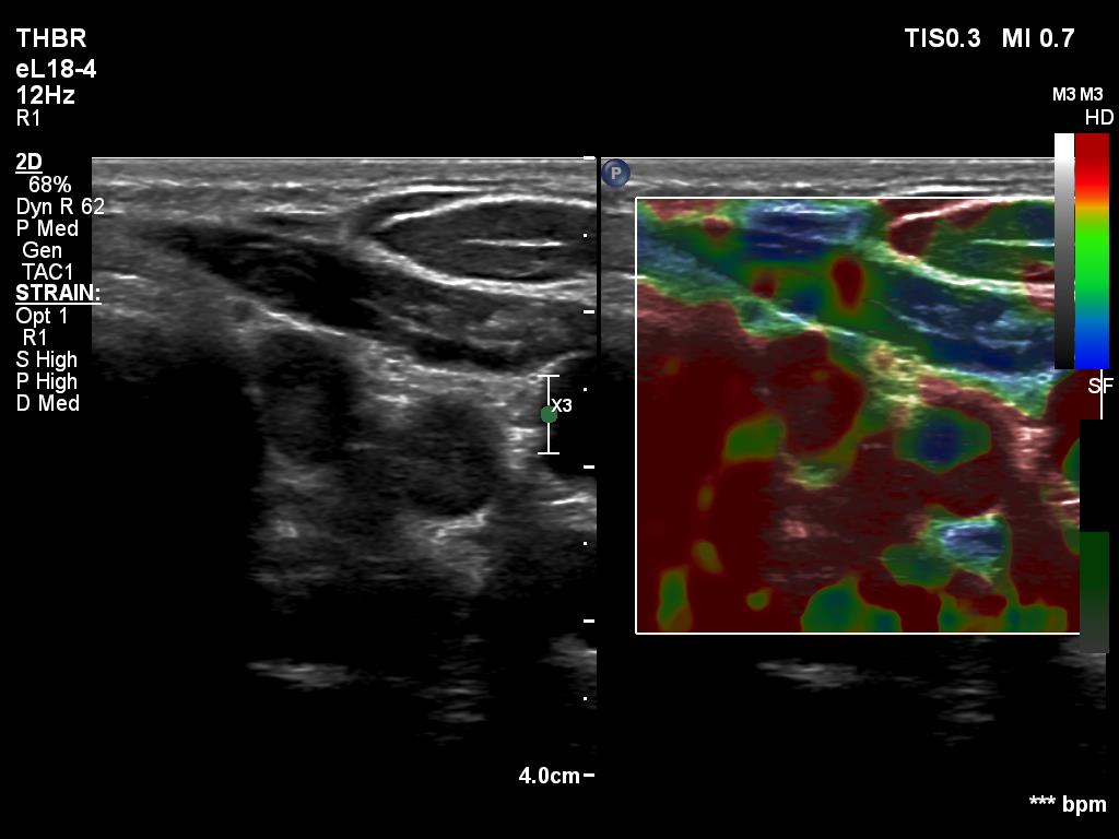 Right lobe, longitudinal scan