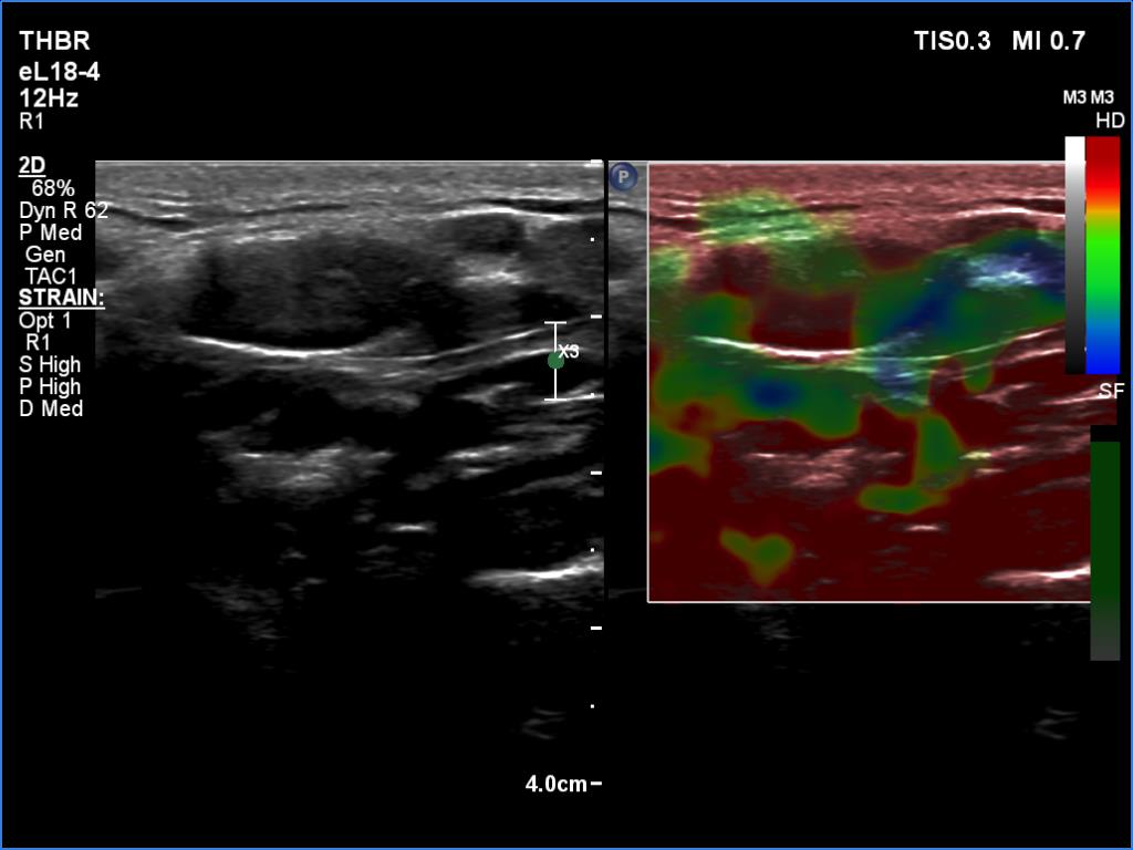 Right lobe, longitudinal scan