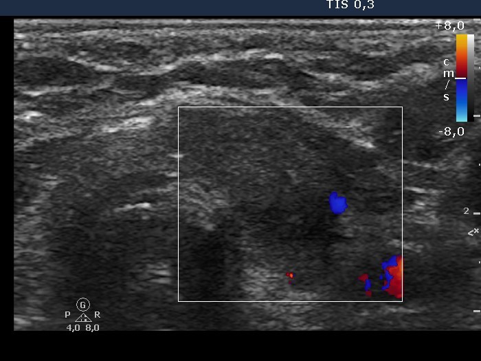 Right lobe, longitudinal scan