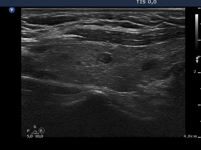 Right lobe, longitudinal scan