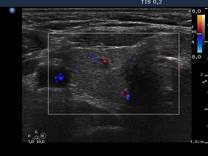Right lobe, longitudinal scan