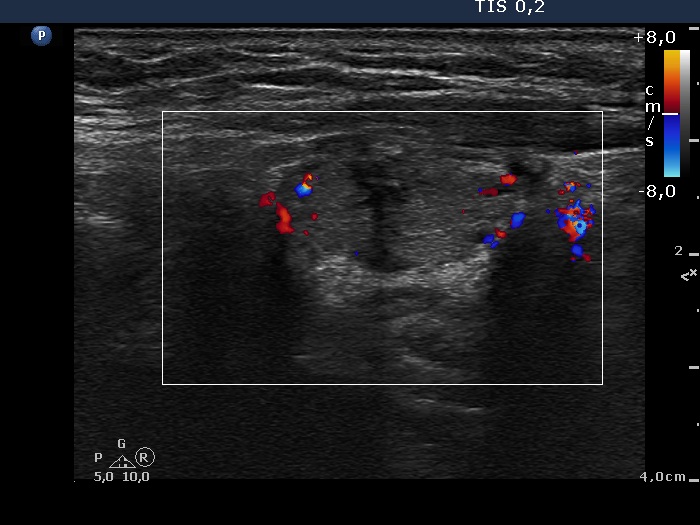 Right lobe, longitudinal scan