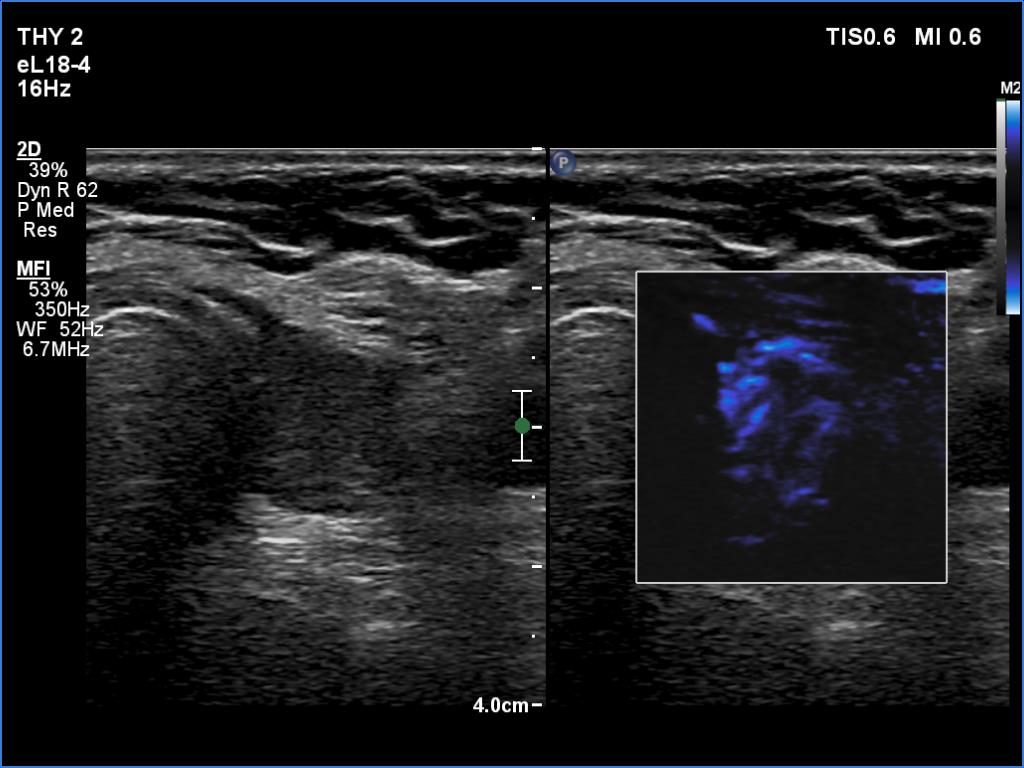 Right lobe, longitudinal scan