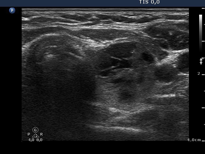 Right lobe, longitudinal scan