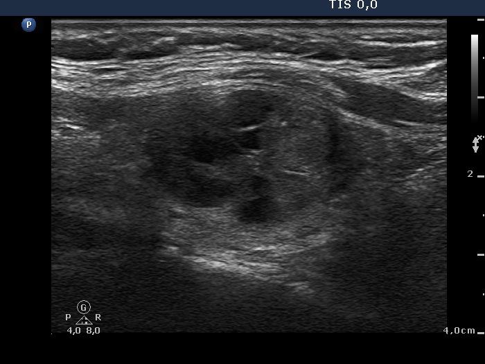 Right lobe, longitudinal scan