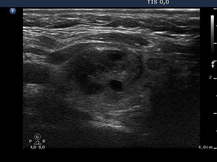 Right lobe, longitudinal scan
