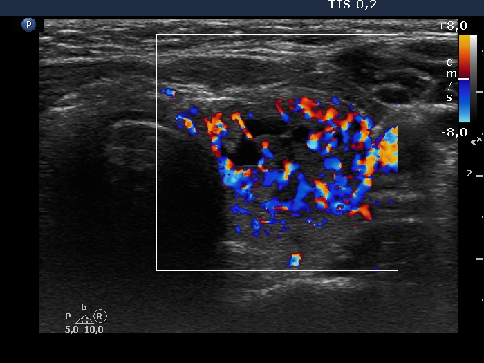 Right lobe, longitudinal scan