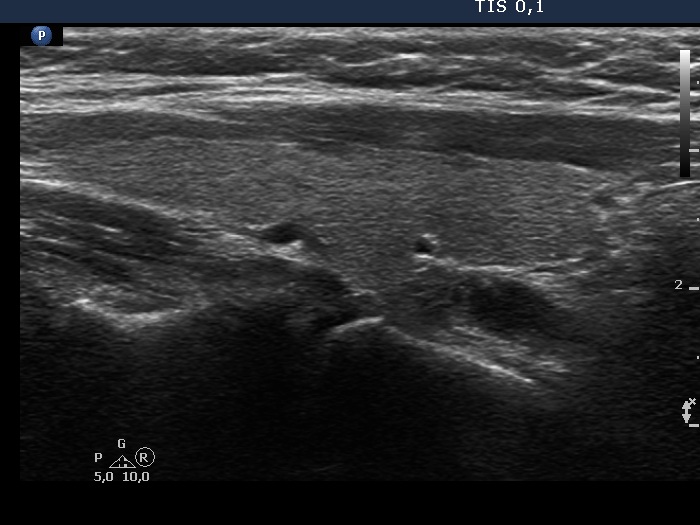 Right lobe, longitudinal scan