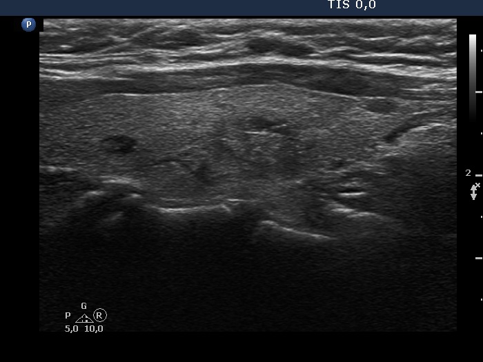 Right lobe, longitudinal scan