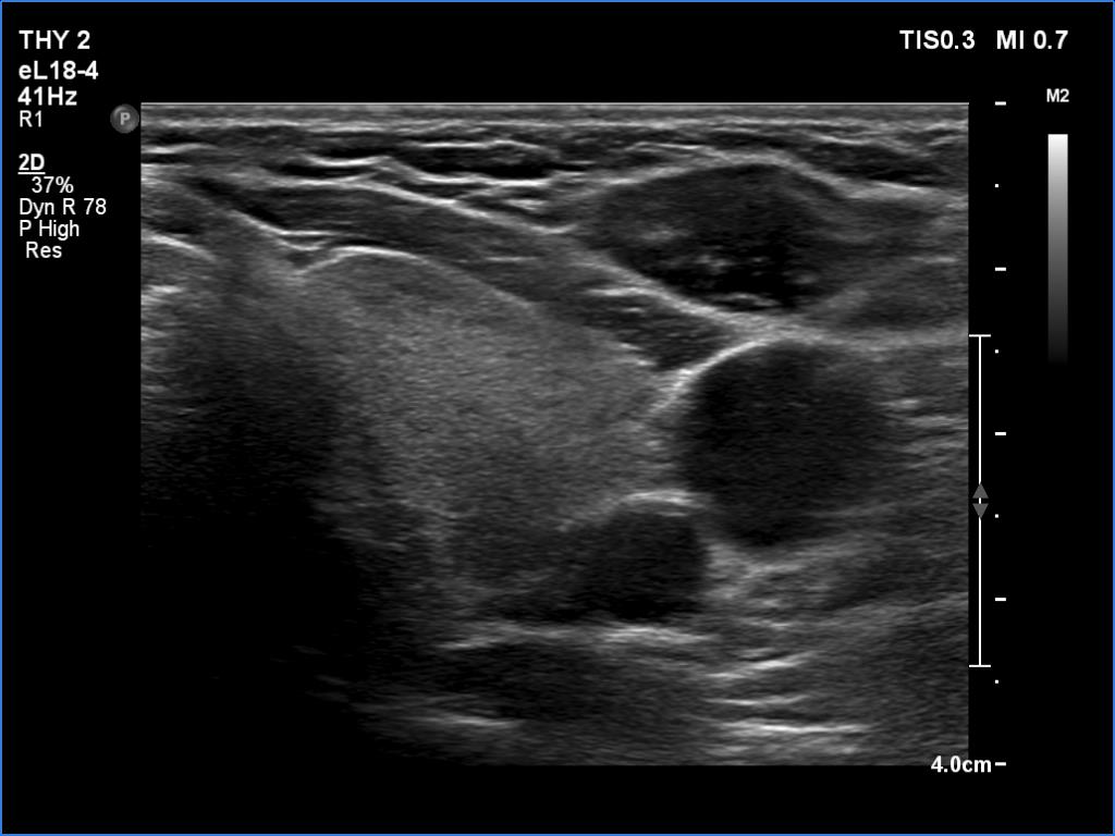 Right lobe, longitudinal scan