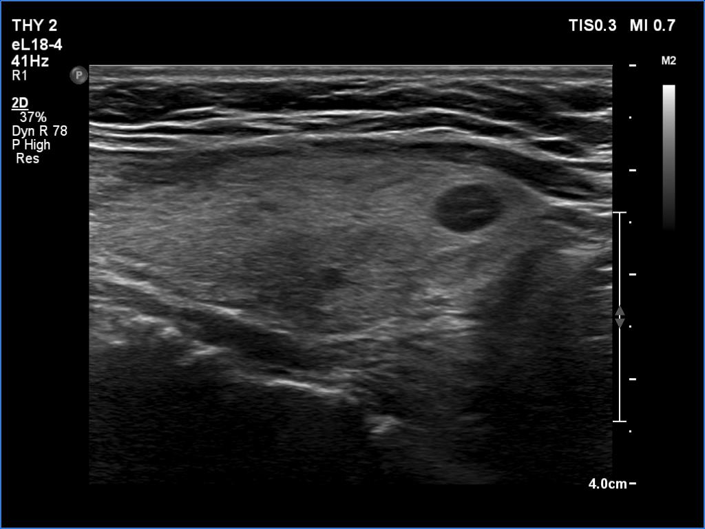 Right lobe, longitudinal scan