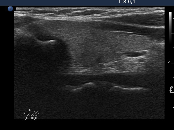 Right lobe, longitudinal scan