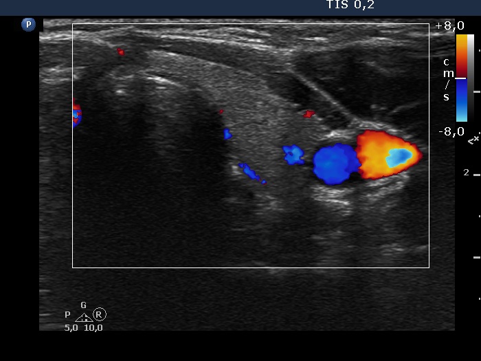 Right lobe, longitudinal scan