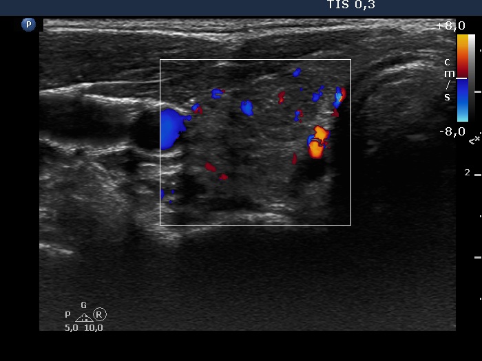 Right lobe, longitudinal scan