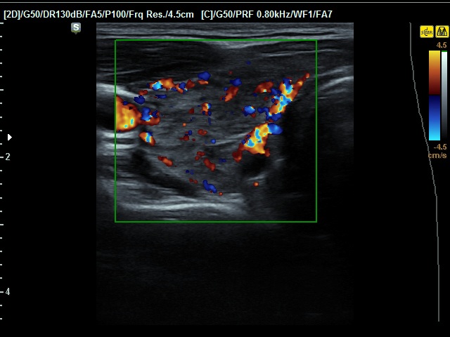 Right lobe, longitudinal scan