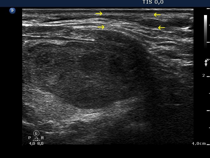 Right lobe, longitudinal scan