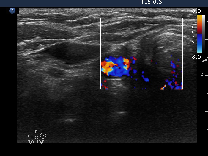 Right lobe, longitudinal scan