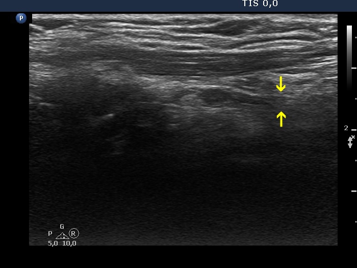 Right lobe, longitudinal scan