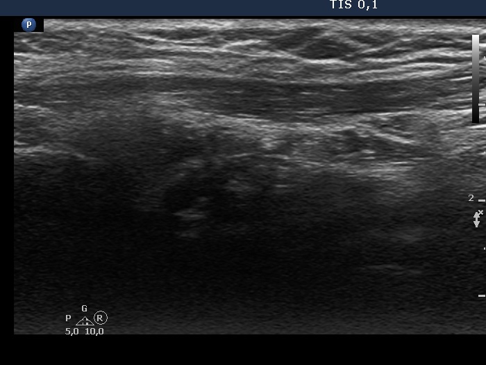 Right lobe, longitudinal scan