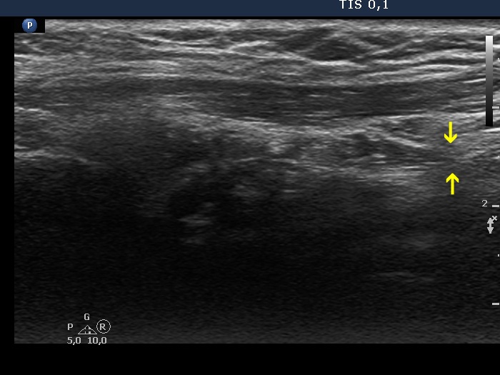 Right lobe, longitudinal scan